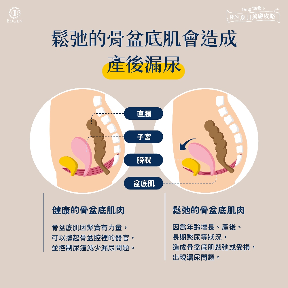 骨盆底肌肉鬆弛造成產後漏尿,產後漏尿原因,博恩妍